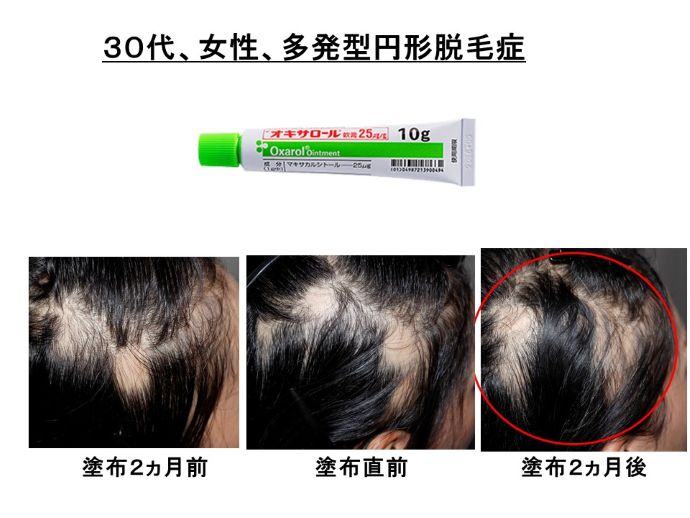 円形脱毛症　病院